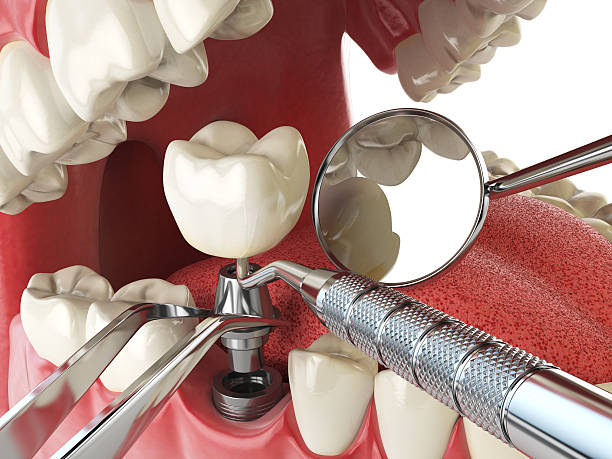 Best Emergency Root Canal Treatment in Moville, IA